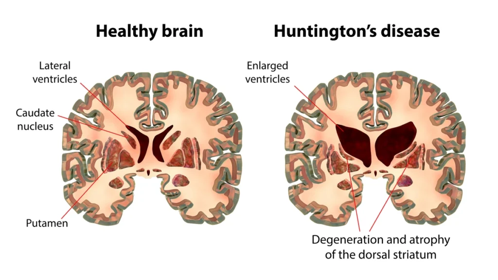 Unmasking Huntington’s Disease: From a Single Gene to a Network of Pathological Signals healthy brain